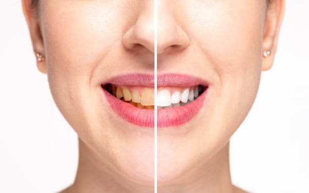 Teeth Whitening Milton Keynes High Wycombe