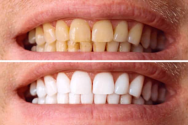 Laser White For Ever Bright – Get a Brighter, Whiter Smile with LA Teeth Whitening High Wycombe