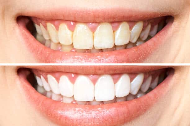 Achieve a Dazzling Smile for Your Special Day: A Guide to Wedding Teeth Whitening High Wycombe