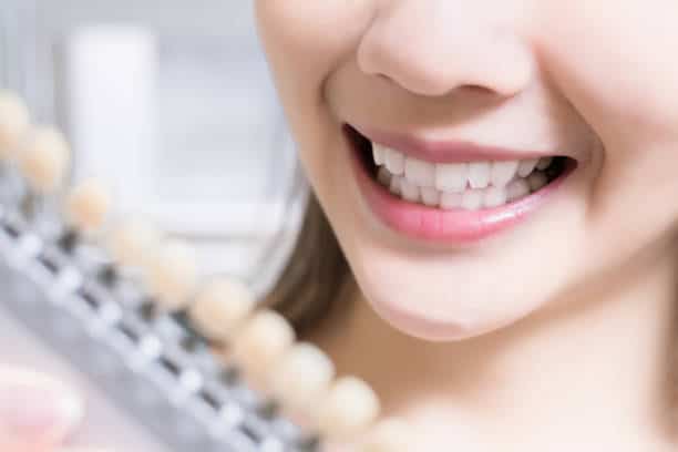 Teeth Whitening Kings Norton High Wycombe