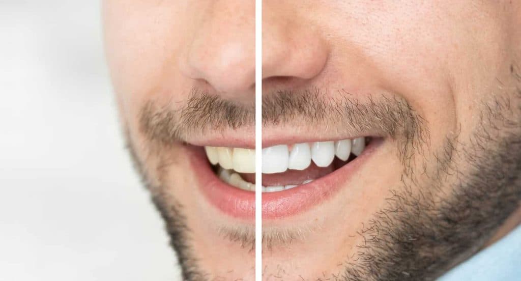 Teeth Whitening Bedfordshire High Wycombe