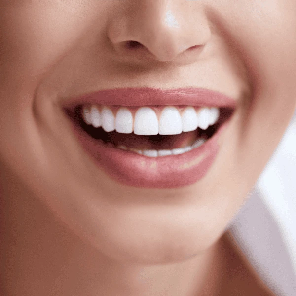 Get A whiter smile fast! Book with LA Teeth Whitening today! High Wycombe